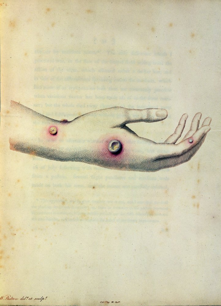 Kuhpockenpustel am Arm von Sarah Nelmes, aus 'Eine Untersuchung der ...