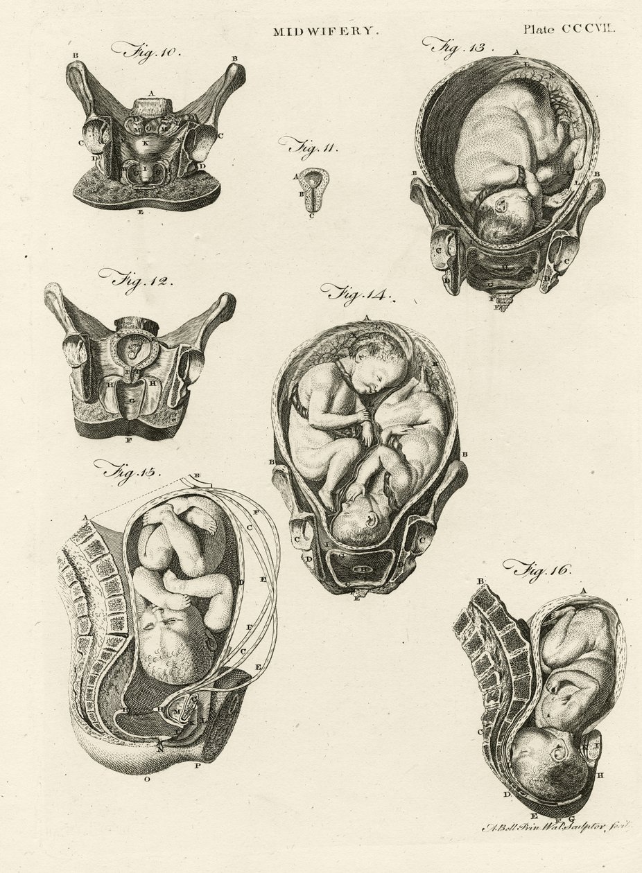 Geburtshilfe, Illustration aus 
