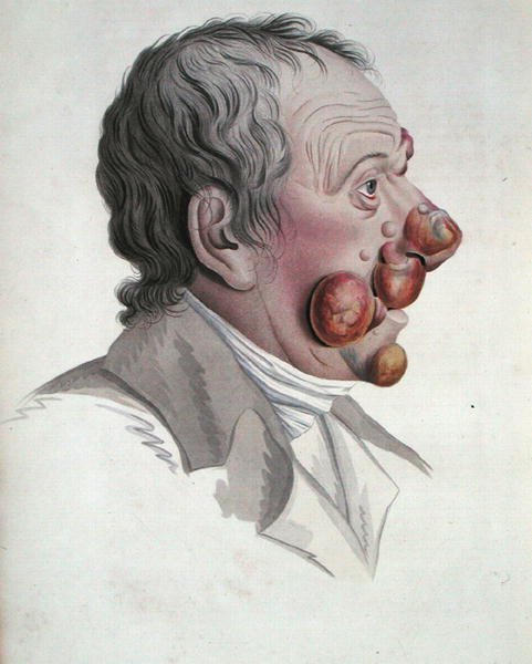Mycosis Fongoide, aus einem Buch von Baron Jean Louis Alibert 1838 von French School