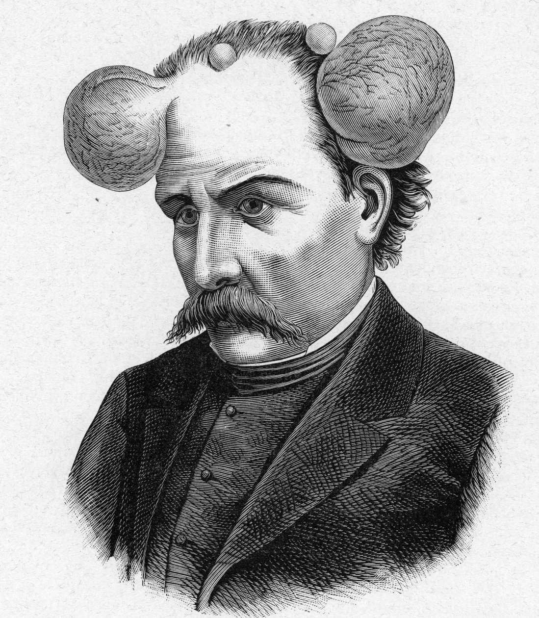 Darstellung einer Person mit Lupe, Kopfzysten (Gravur) von French School