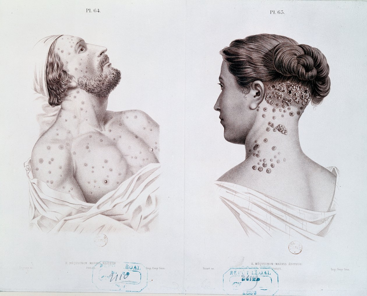 Symptome der Syphilis bei Männern und Frauen, aus einem medizinischen Buch, ca. 1850-60 von French School