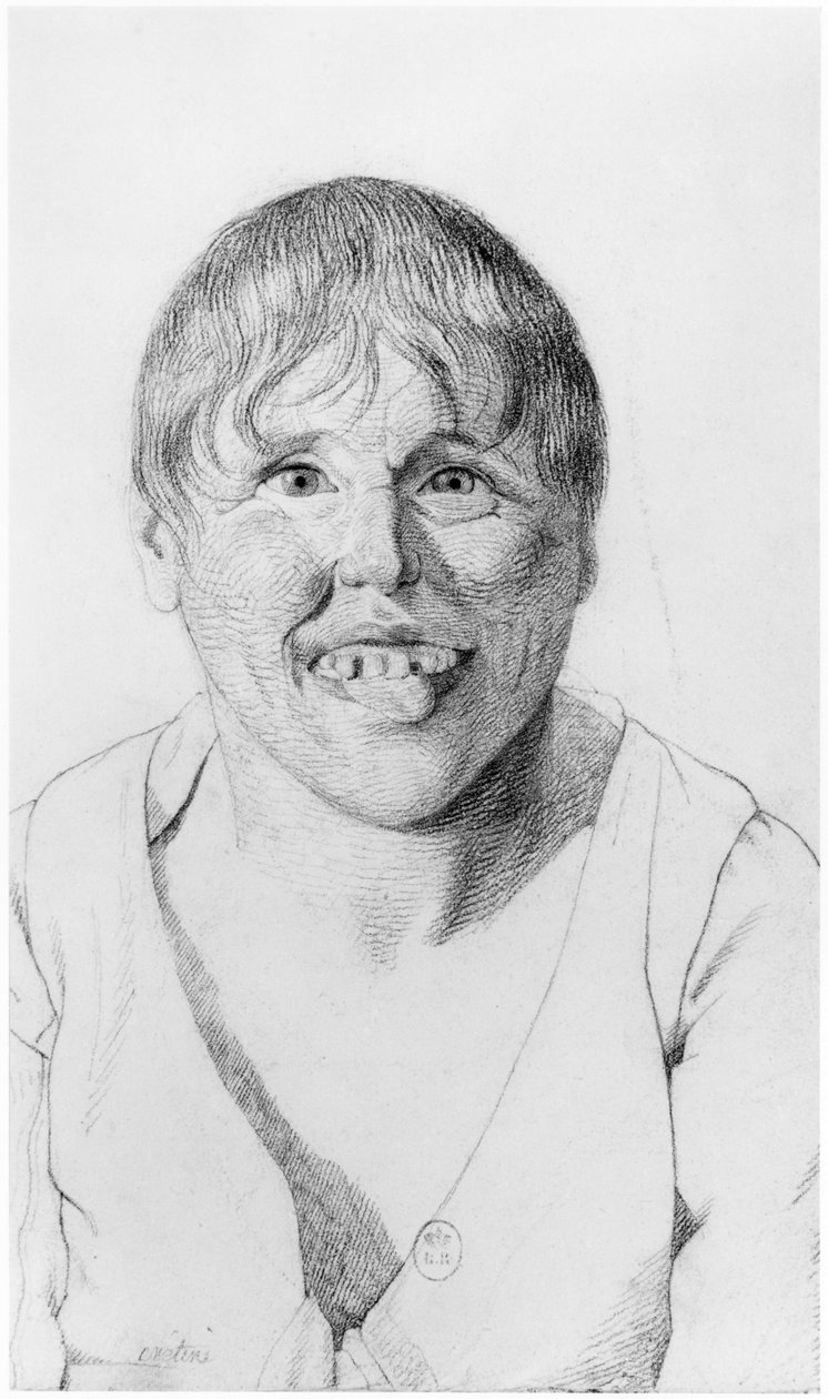 Kretin, Vorderansicht, Illustration aus einer unveröffentlichten Abhandlung von Jean Etienne Dominique Esquirol (1772-1840) über die Geisteskranken des Salpetriere-Asyls, ca. 1818 von Georges Francois Gabriel