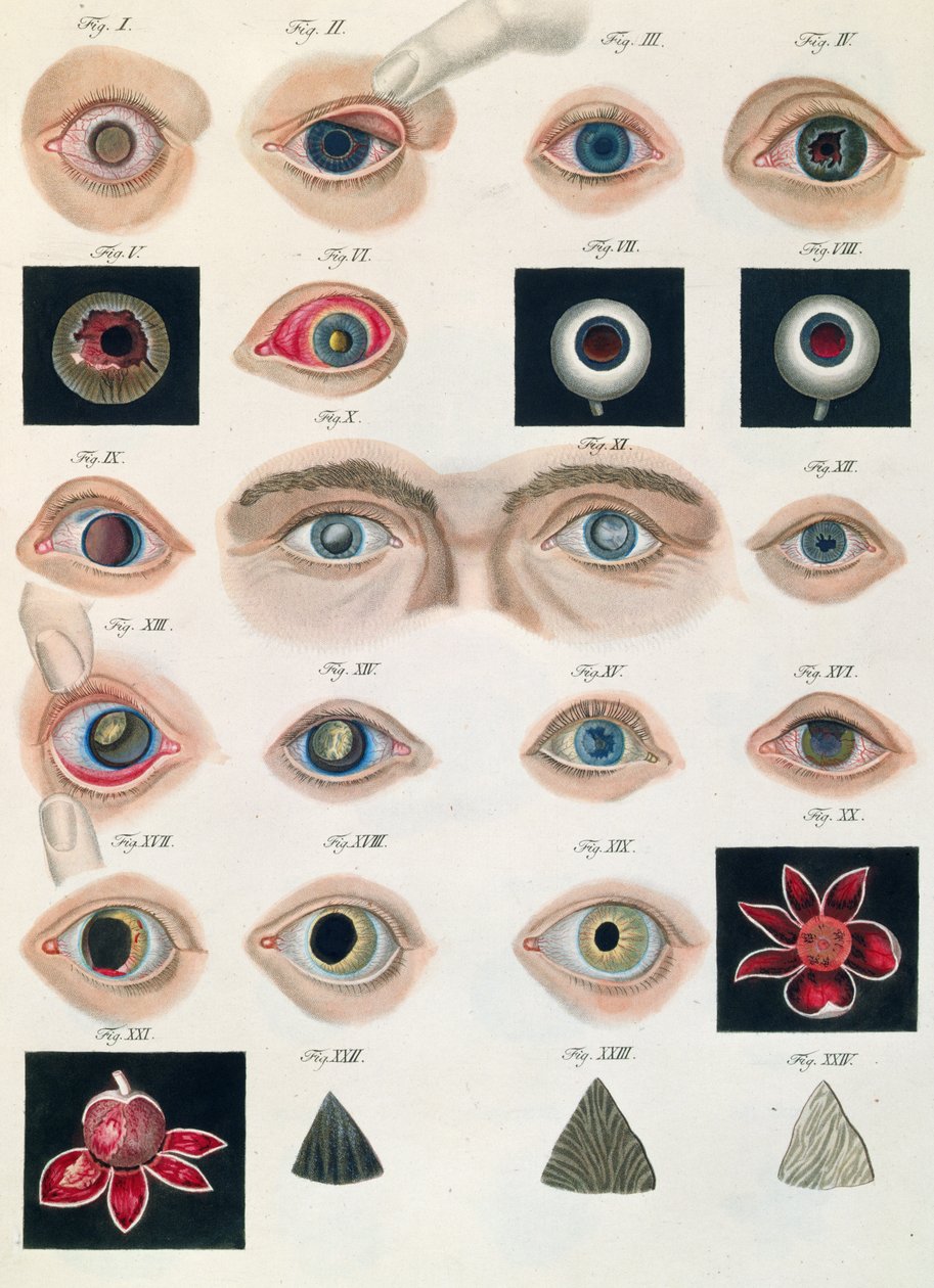 Beschreibung angeborener Augenanomalien, aus Klinische Darstellungen der Krankheiten und Bildungsfehler des menschlichen Auges, von Friedrich August von Ammon (1799-1861) 1838 von German School