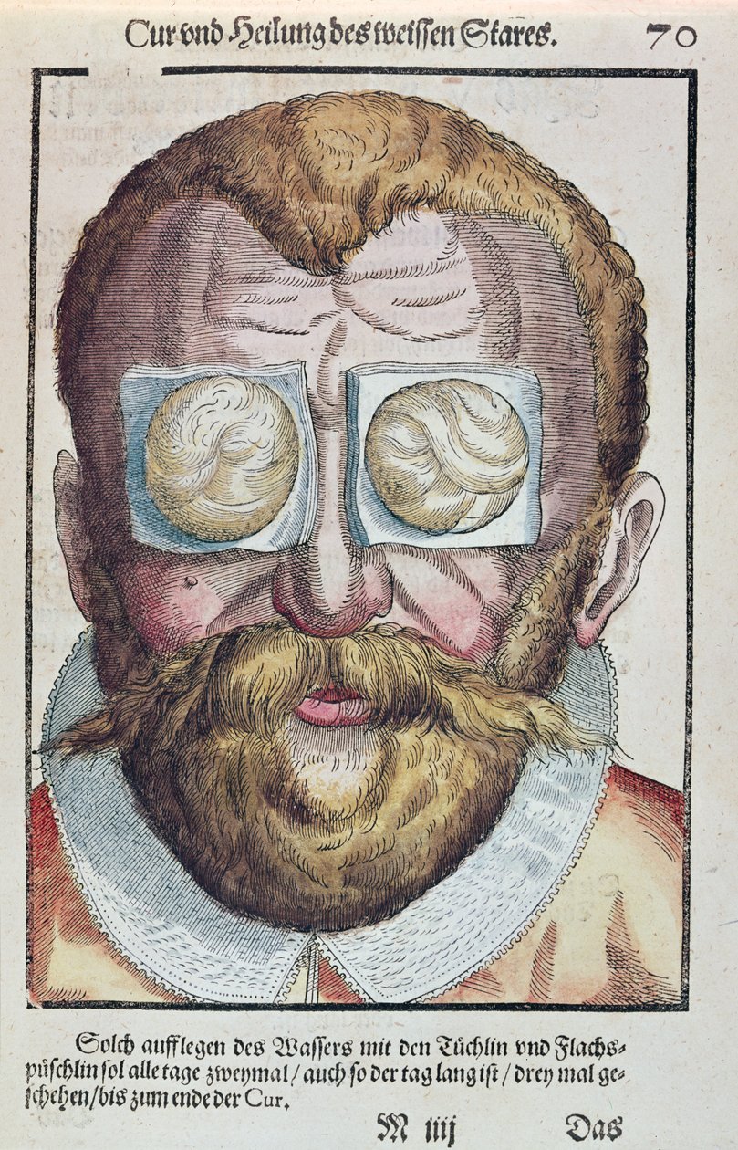 Behandlung einer Augenkrankheit, aus Ophthalmodouleia von Georg Bartisch (1535-1636) veröffentlicht in Dresden 1583 (Farbholzschnitt) von German School