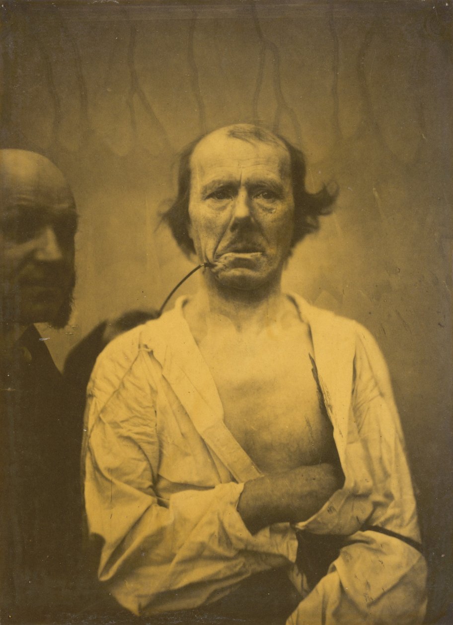 Ein entspanntes Gesicht (links); Ekel (rechts) von Guillaume Benjamin Amant Duchenne