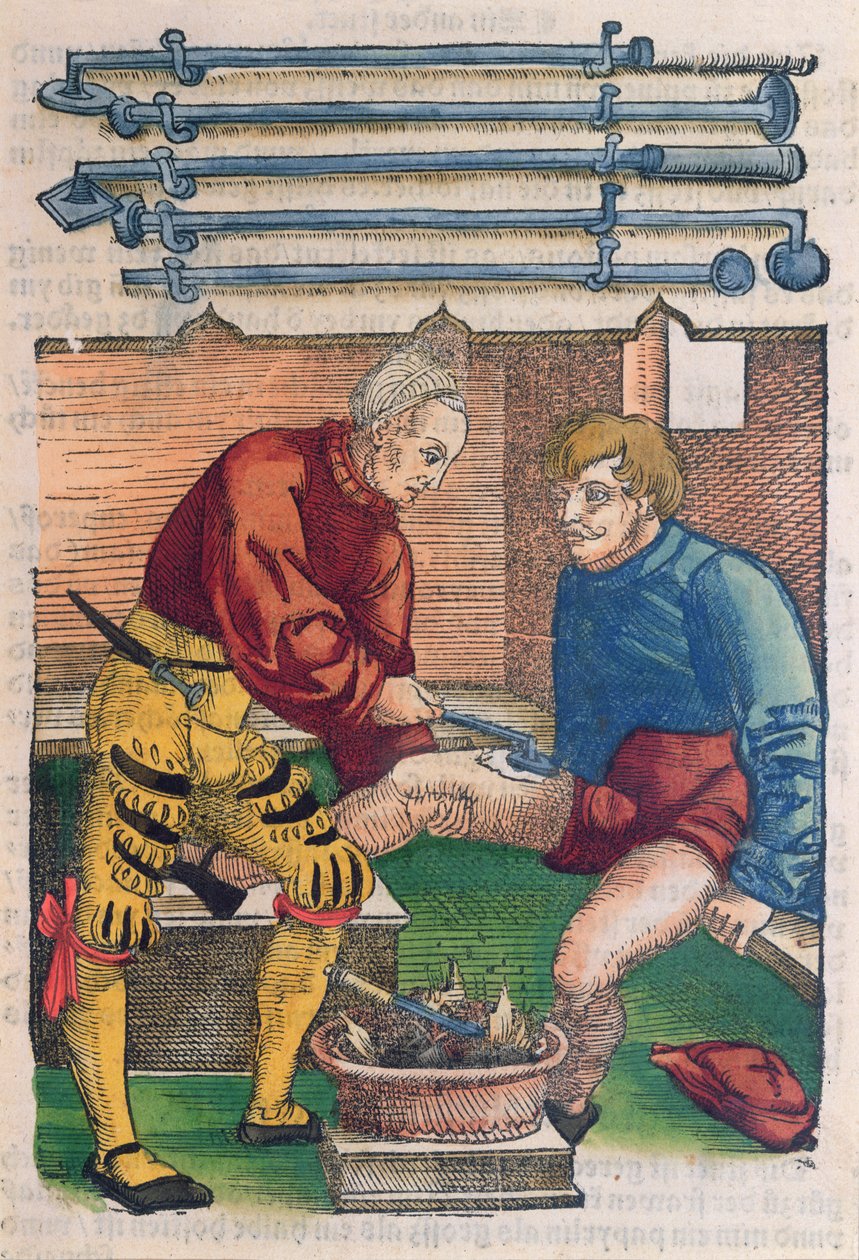 Kauterisation, Illustration aus 