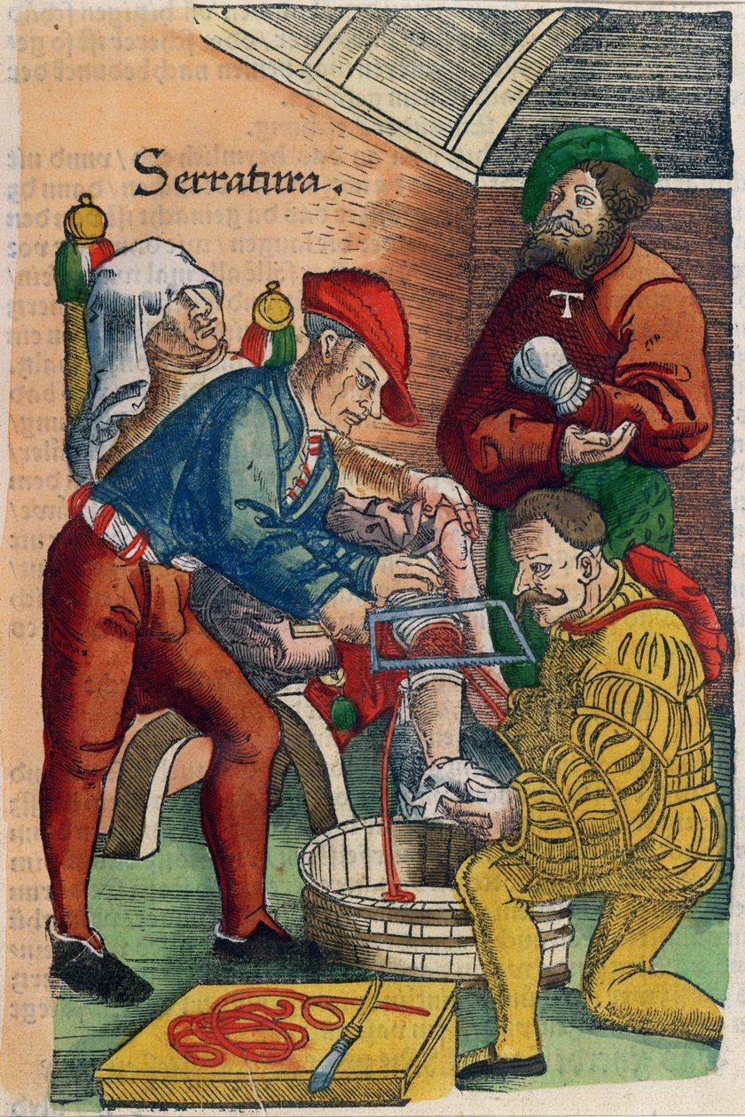 Eine Amputation, Illustration aus 