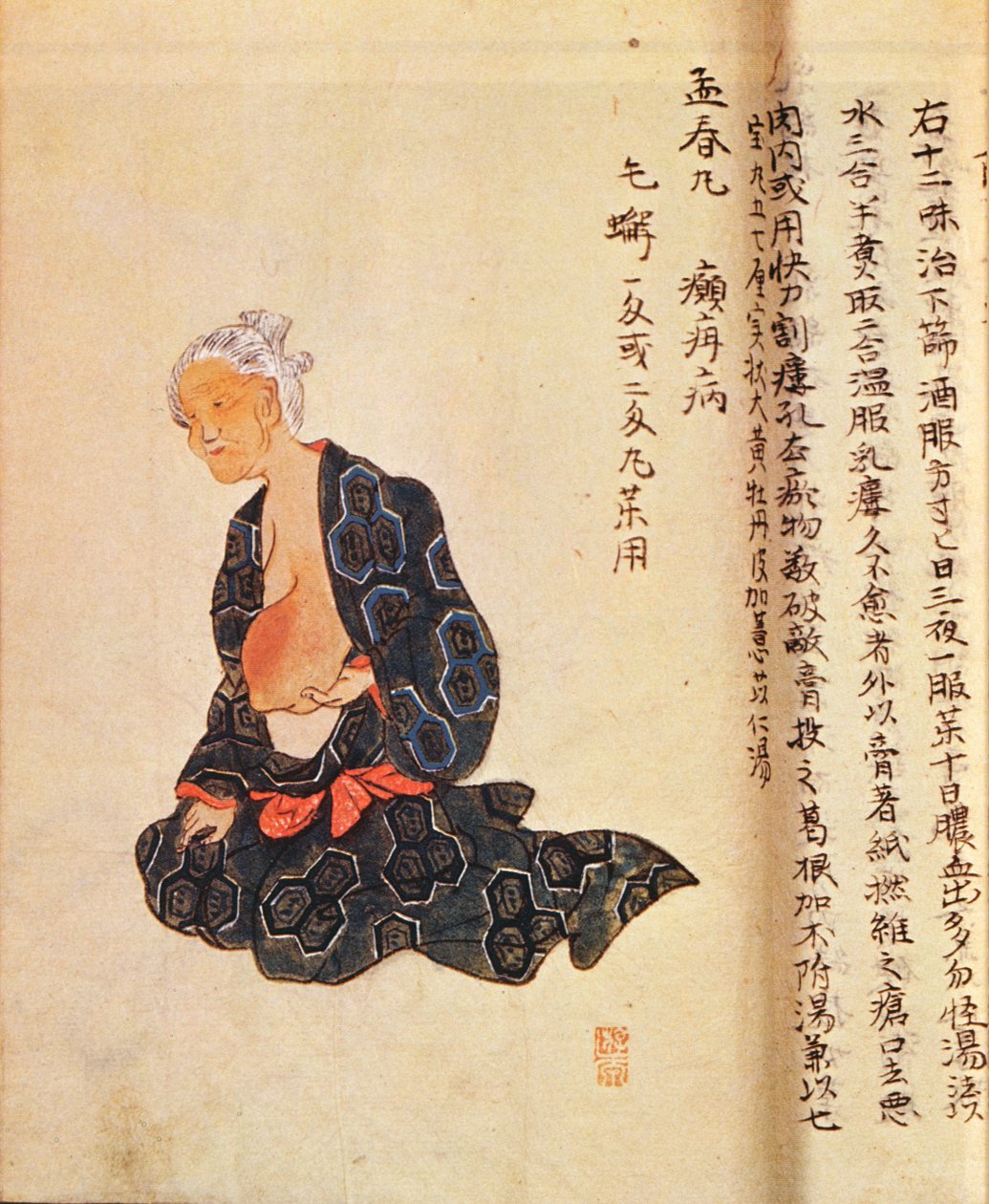 Die erste chirurgische Behandlung von Brustkrebs unter Vollnarkose durchgeführt von Seishu Hanaoka (1760-1836) im Jahr 1804 von Japanese School