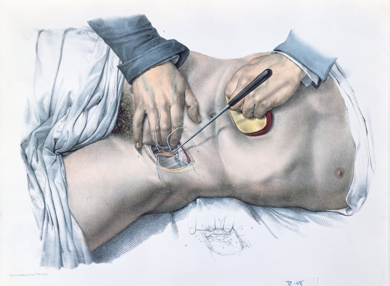 Abbindung einer Arterie, Platte aus 