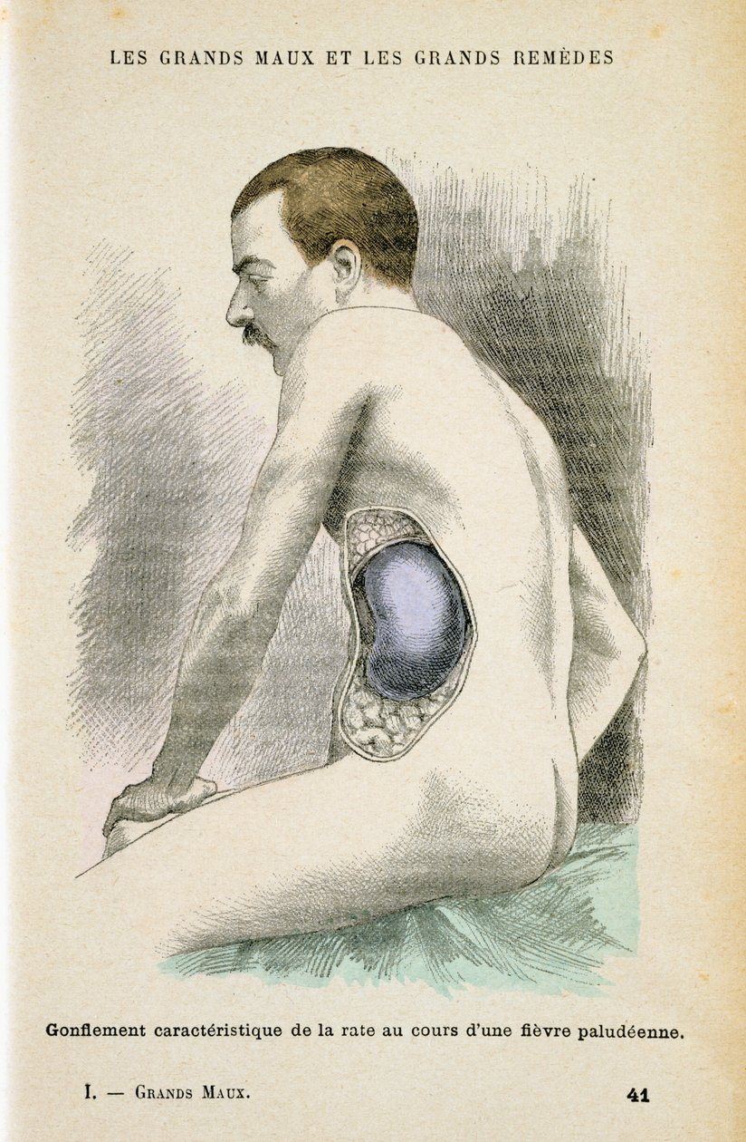 Typische vergrößerte Milz eines Malariapatienten, ca. 1890 von Unbekannt