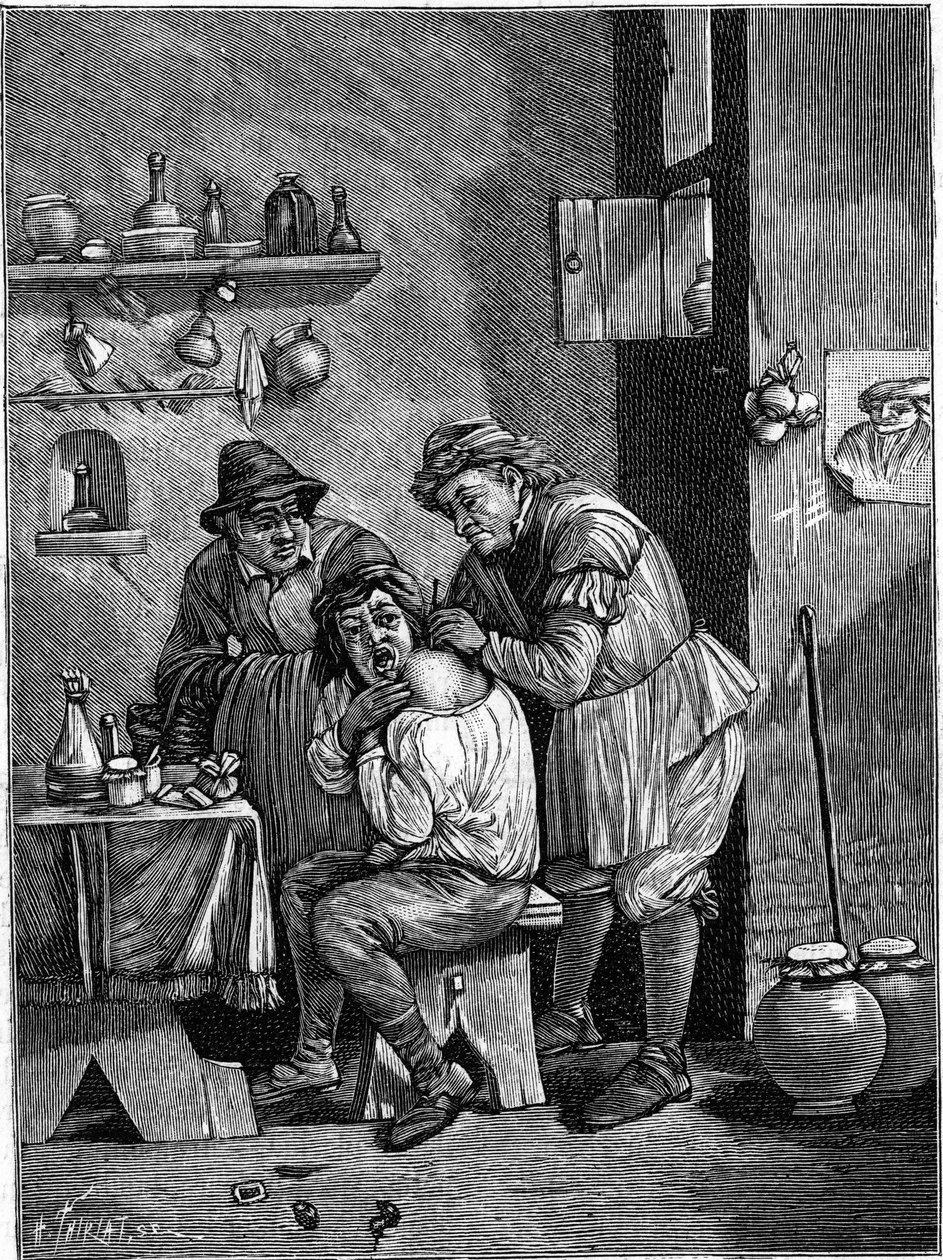 Ein Scharlatan-Chirurg im 18. Jahrhundert untersucht eine Schulterverletzung. (Nach einer Gravur der Zeit). Gravur in „La Nature: revue des sciences et de leurs applications aux arts et a l