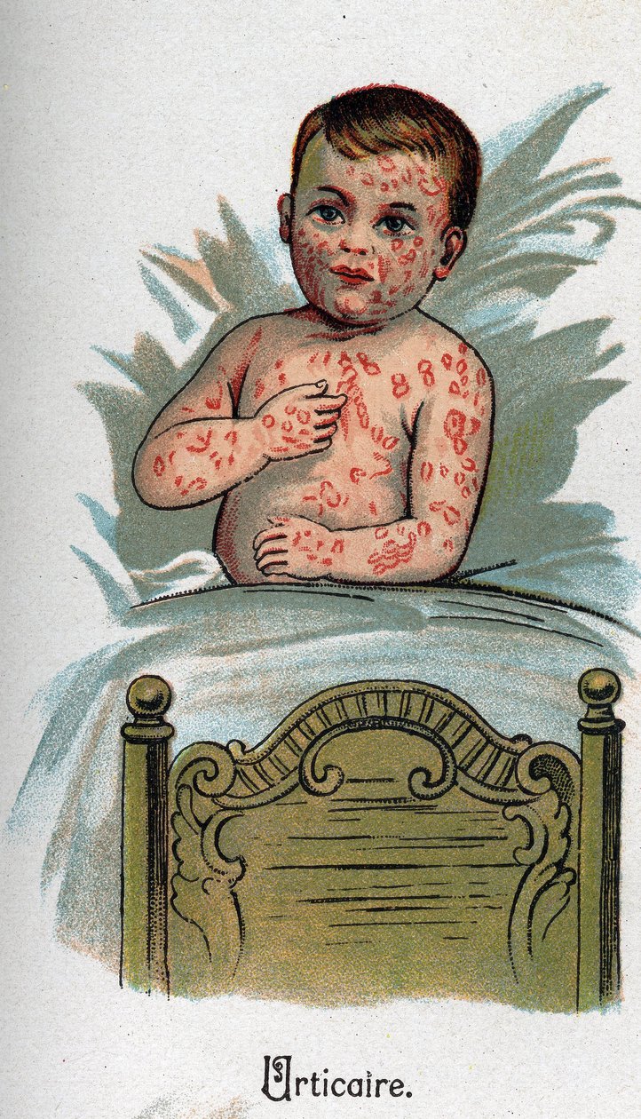 Kinderkrankheiten: Nesselsucht. In „Die neue Naturmedizin“ von F.E. Bilz. von Unknown artist