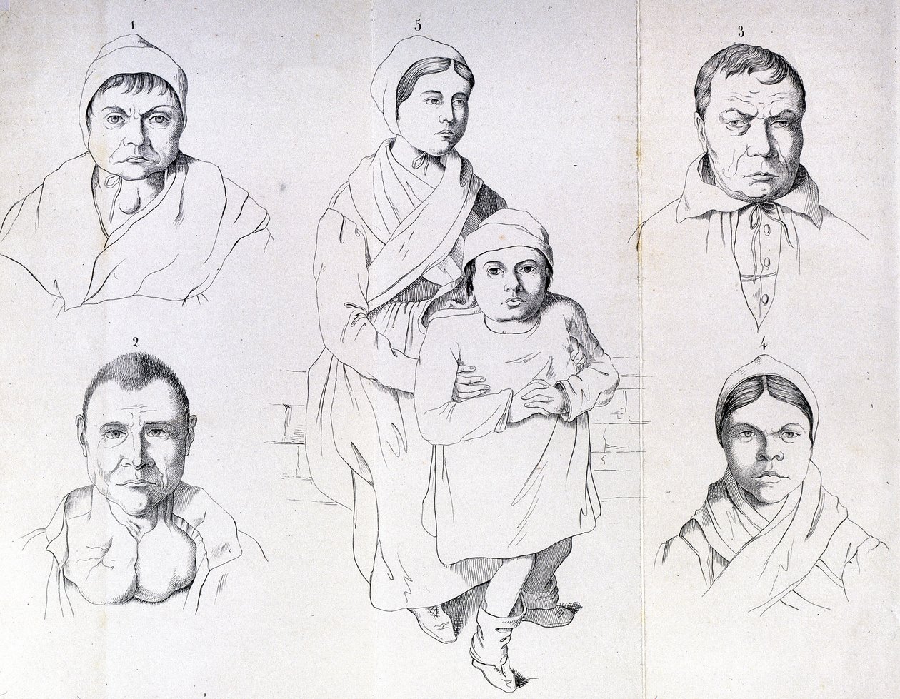 Überlegungen zu den Ursachen des endemischen Kretinismus von Morel. von Unknown artist