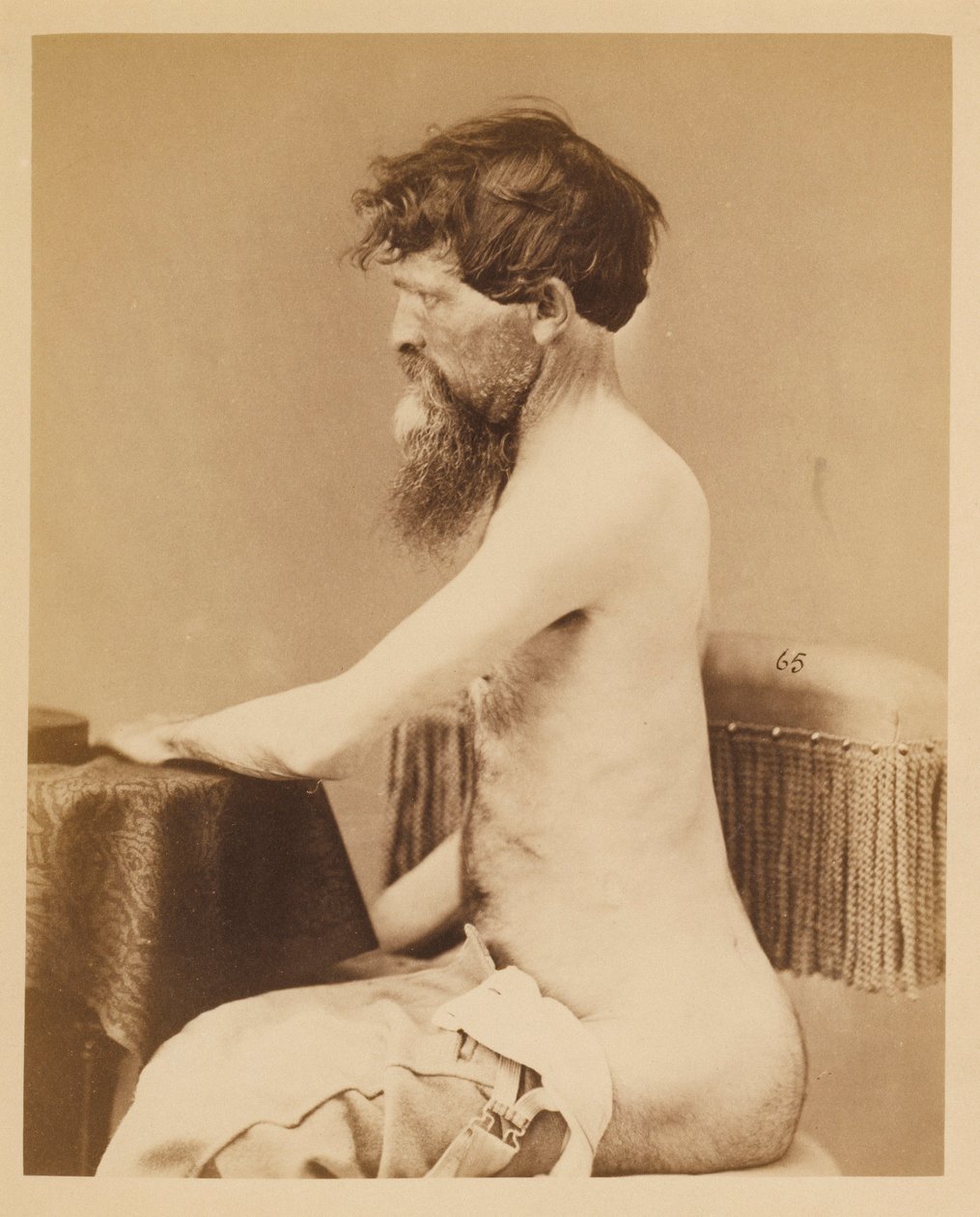 Private John Bar, Genesung nach einer Durchdringenden Bauchverletzung mit Bruch des Linken Os Innominatum, aus dem Fotografischen Katalog der Chirurgischen Abteilung von William Bell