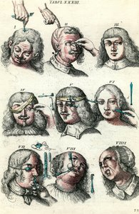 Chirurgie im 18. Jahrhundert: Trepanation und Operation von Auge und Gesicht. Gravur in „Institutionis chirurgicae“ von Lorenzo Heister von Anonymous Anonymous