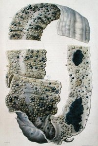 Krankheiten des Darms, aus 