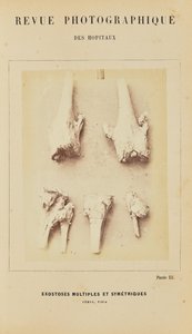 Mehrfache und symmetrische Exostosen, Femur, Tibia von Arthur de Montmeja