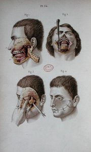 Anatomische Platte des Oberkiefers von C and Huette E. Bernard