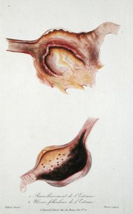 Erweichung und Follikelgeschwüre des Magens, aus 