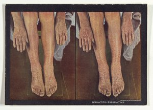 Dermatitis Exfoliativa von Dr. Selden I. Rainforth