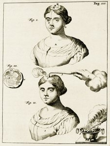 Behandlung eines Epilepsiekranken, aus Exercitationes Practicae circa Medendi Methodum von Frederik Dekkers, 1694