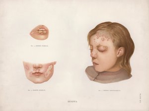 Hautkrankheiten: Herpes von English School