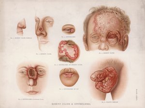Hautkrankheiten: Nagetiergeschwür und Epitheliom von English School
