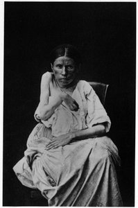 Fotografie eines Patienten mit hemiplegischer Epilepsie, in „photographische Ikonographie der Salpêtrière“, Bourneville und P. Regnard, Paris von French Photographer