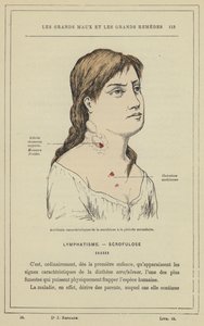 Charakteristische Unfälle der Skrofulose in der Sekundärperiode von French School