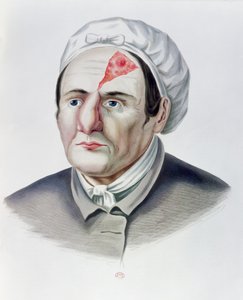 Nach einer Hauttransplantation, aus Selecta Praxis Medico-Chirurgica von Alexander Auvert, Paris, 1856 von French School