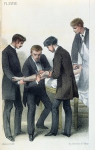 Amputation eines Arms, aus einem medizinischen Handbuch von Jean-Baptiste-Leon Dubreuil, ca. 1850-60 von French School