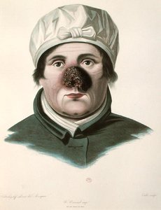 Vor einer Hauttransplantation, aus 