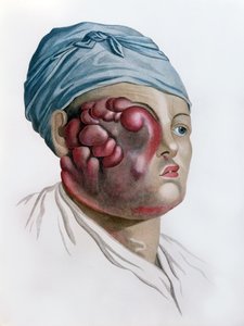 Krebsartige Skrofulose, aus Description des Maladies de la Peau von Baron Jean Louis Alibert (1768-1837) Paris, 1806