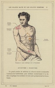 Arthritische Eruptionen bei einem Rheumatiker von French School