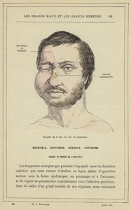 Fortschreitendes Gesichts-Erysipel von French School