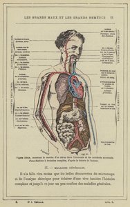 Ideale Figur, die den Verlauf eines Virus im Körper und die aufeinanderfolgenden Unfälle einer vollständigen Diathese zeigt, nach der Theorie des Autors von French School