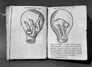 Fötus im Mutterleib, Illustration aus dem sogenannten Rhodion-Manuskript