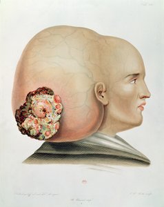 Pilz des Dura Mater, aus Selecta Praxis Medico-Chirurgica von Alexander Auvert, Paris, 1856