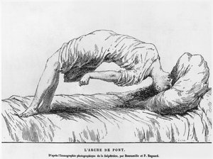 Hysterie und Schlafwandeln, aus Les Maladies Epidemiques de l