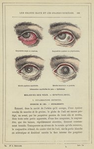 Oberflächliche Augenentzündungen, Ophthalmien von French School