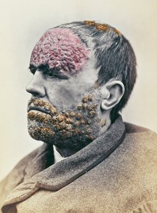 Mann leidet an Syphilis, aus einem Foto für die Clinique Photographique de l