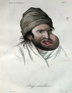 Maxillärer Polyp, aus einem Buch von Baron Jean Louis Alibert 1817 von French School