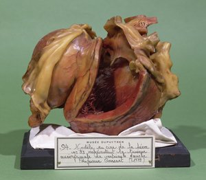 Modell eines Tumors des linken Ventrikels, 1799 von French School