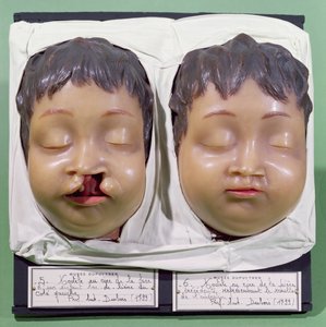 Modell, das ein Kinder Gesicht vor und nach einer Operation zur Korrektur einer Hasenscharte zeigt, durchgeführt von Antoine Dubois (1756-1837) im Jahr 1799 (Wachs) von French School