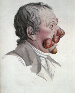 Mycosis Fongoide, aus einem Buch von Baron Jean Louis Alibert 1838 von French School