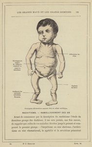 Hauptsächliche Knochendeformationen bei einem rachitischen Kind von French School