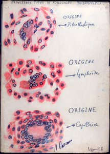Prinzipielle Tuberkulose-Follikel von French School