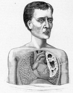 Darstellung einer Person mit Höhlen, Komplikation der Tuberkulose (Gravur) von French School