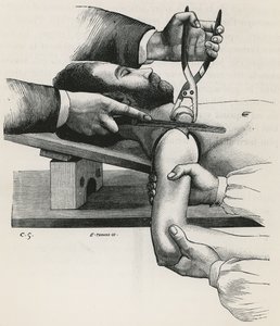 Resektion der Schulter, aus 