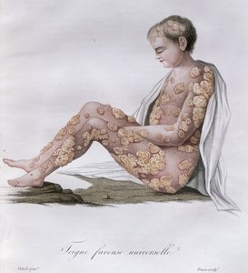 Ringelflechte, aus einem Buch von Baron Jean Louis Alibert (1768-1837) 1838